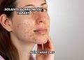 Solante Acnes Ne İşe Yarar?