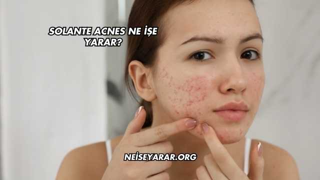 Solante Acnes Ne İşe Yarar?