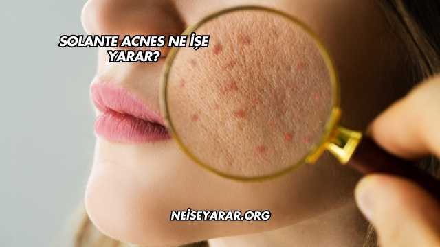 Solante Acnes Ne İşe Yarar?