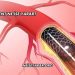 Stent Ne İşe Yarar?