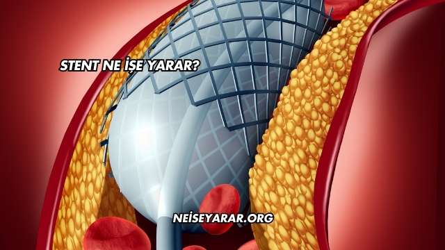 Stent Ne İşe Yarar?